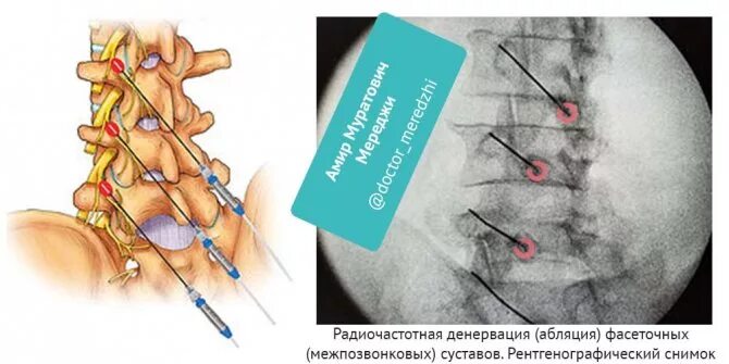 Фасеточная блокада. Денервация фасеточных суставов шейного отдела. Радиочастотная деструкция фасеточных суставов поясницы. Денервация суставов позвоночника. Радиочастотная денервация позвоночника Axis.