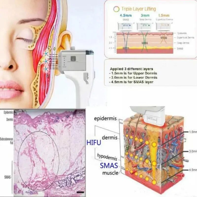 Smas лифтинг skinlift. Аппарат смас лифтинг 4 д. Аппарат смас лифтинг HIFU. Альтера аппарат для смас лифтинга. Аппарат для smas -лифтинга hironic.