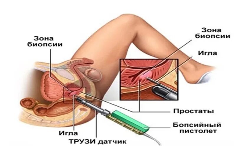Как делают биопсию мужчинам. Трансректальное УЗИ предстательной железы. Ректальный датчик для УЗИ. Ультразвуковое исследование предстательной железы трансректальн. Пункционная биопсия предстательной железы.