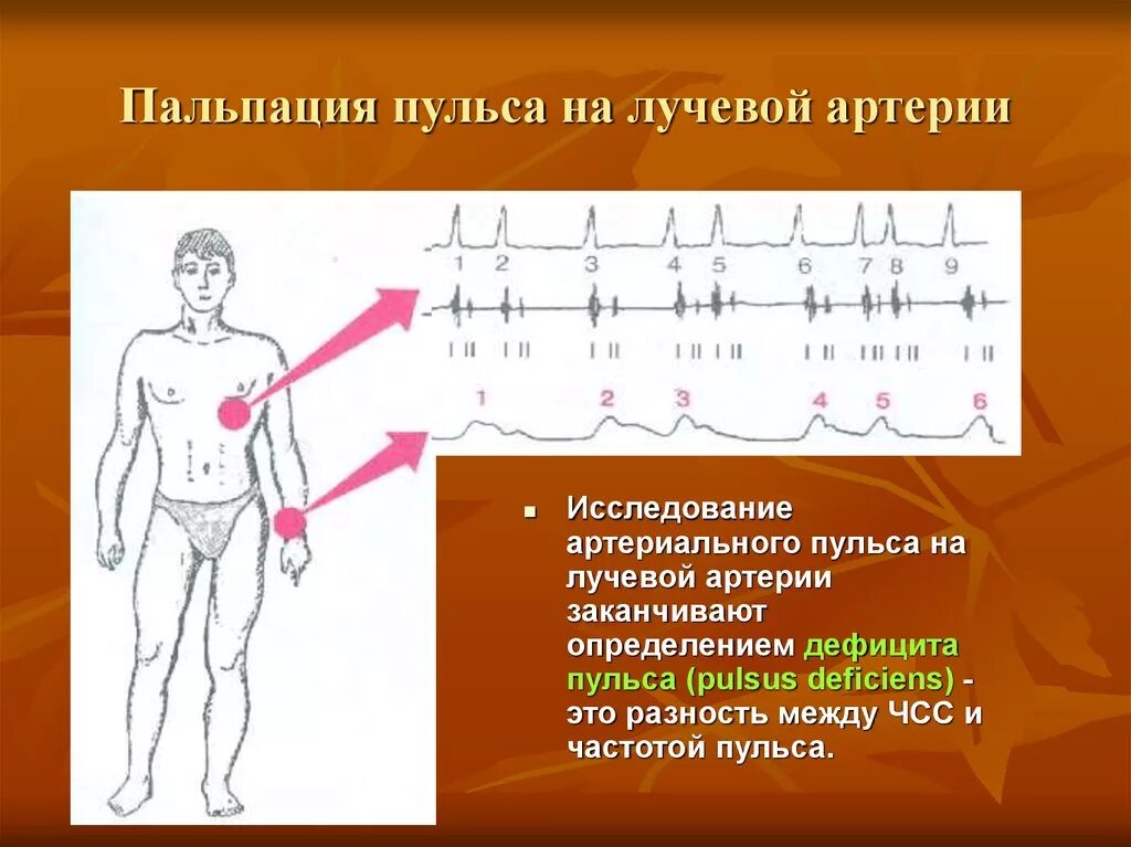Дефицит артериального пульса. Пальпация артериального пульса. пальпация пульса на лучевой артерии. прощупывание пульса на лучевой артерии.