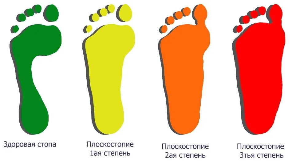 Стопа с плоскостопием 3 степени. Продольное плоскостопие 2 степени. Продольное плоскостопие степени. Поперечное iii - iv степени плоскостопие. Плоскостопие 2 степени что это.