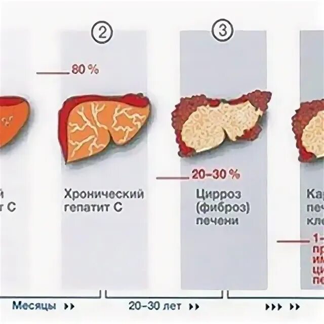 Выраженный фиброз