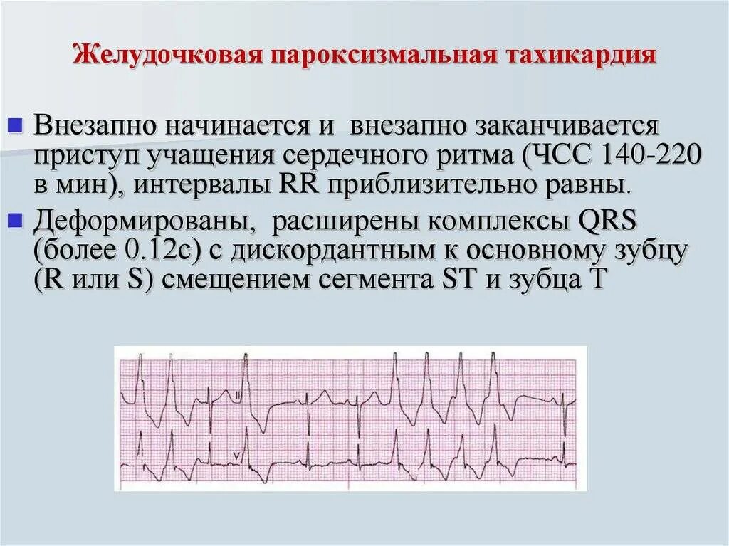 Пароксизмальная желудочковая тахикардия на ЭКГ. Желудочковая форма пароксизмальной тахикардии на ЭКГ. ЭКГ при пароксизмальной наджелудочковой тахикардии. Желудочковая тахикардия на ЭКГ ЧСС.