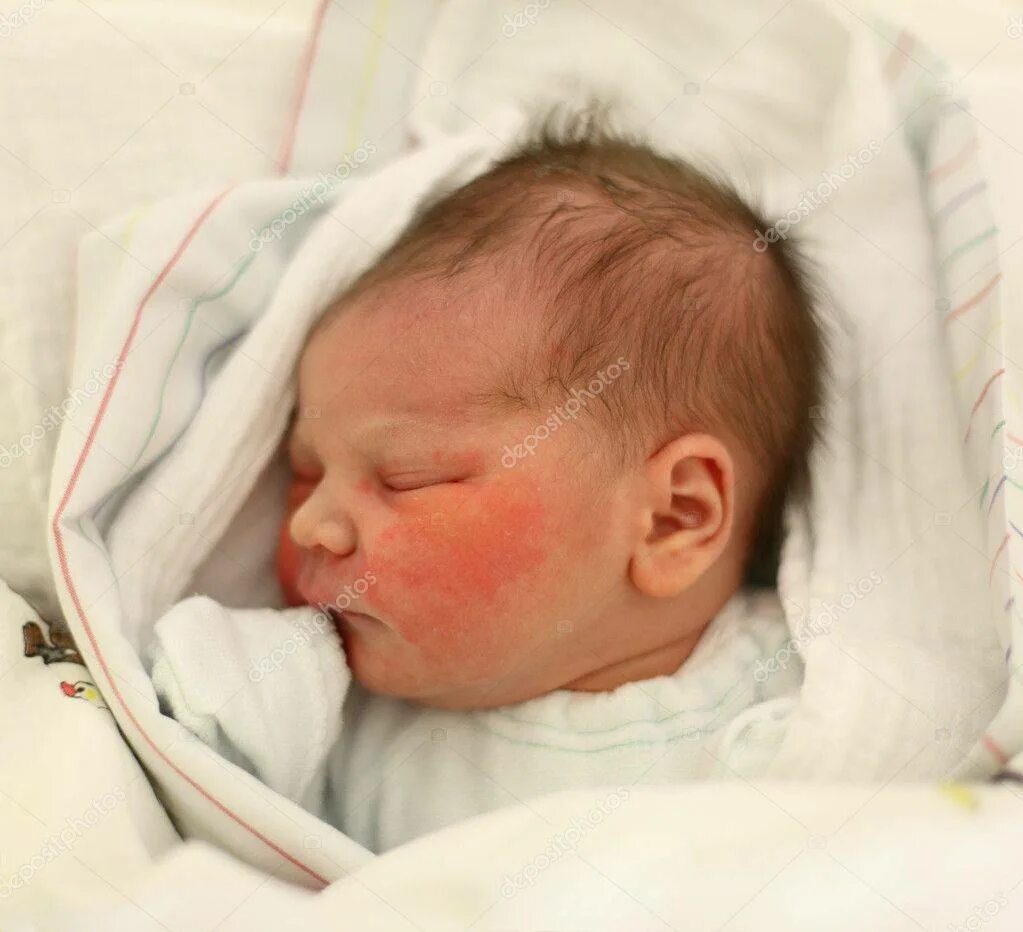 цветущая фото у детей новорожденных. цефалический пустулез новорожденных. период цветения у новорожденного. цветение новорожденных. что значит дети цветут новорожденные.