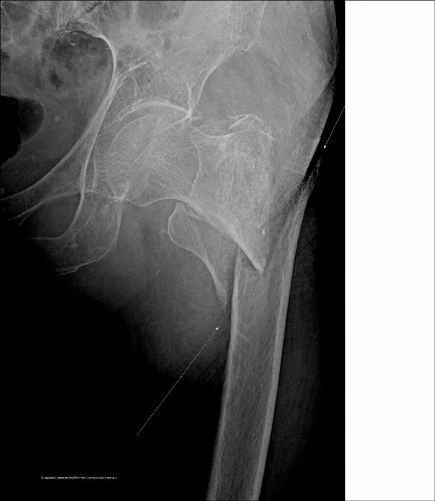 Трещина тазобедренного. Чрезвертельный перелом бедренной кости рентген. Межвертельный перелом бедра рентген. Чрезвертельный перелом бедра рентген. Подвертельные переломы бедренной кости.