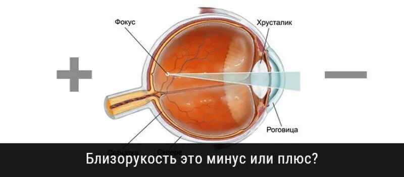 Зрение плюс 5. Близорукость это плюс или минус. Близорукость это плюс или минус очки. Близорукость это + или -. Близорукости глаза это минус или плюс.