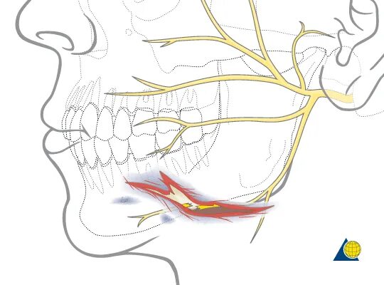 Киста нижней челюсти и тройничный нерв. Неврит нижнечелюстного нерва симптомы. Неврит альвеолярного нерва. Тройничный нерв в челюсти. Лицевой нерв челюсти
