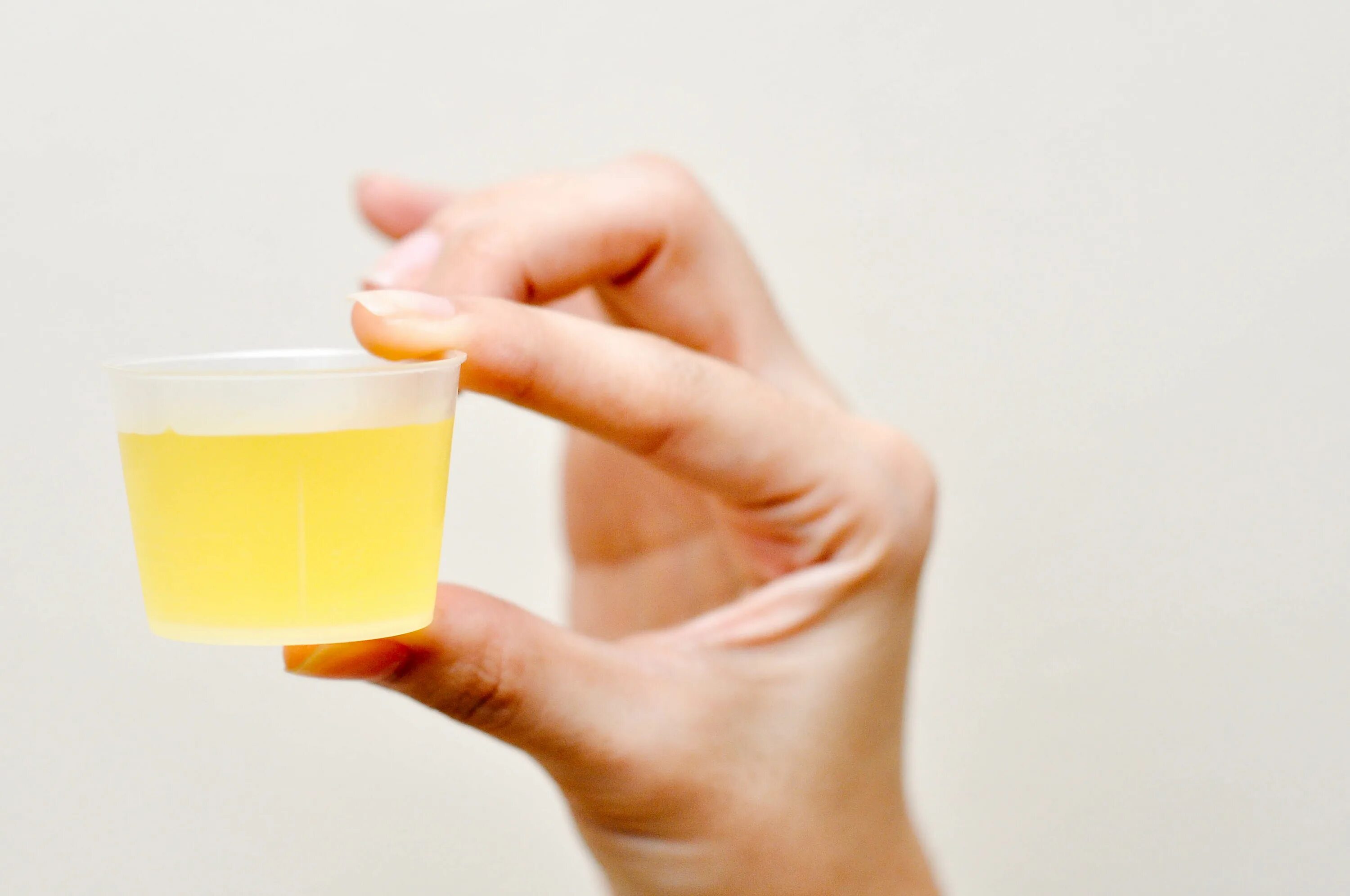 моча тёмнгжёллого цвета. цвет мочи. изменение цвета мочи. моча насыщенно желтого цвета. лимонная моча у женщин.