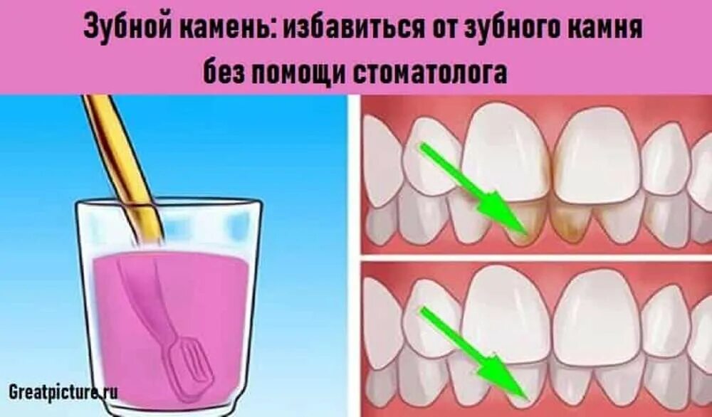Как чистить зубы после удаления зуба. Зубной камень у подростка. эффективное средство от камня на зубах. убираю иголкой зубной камень.