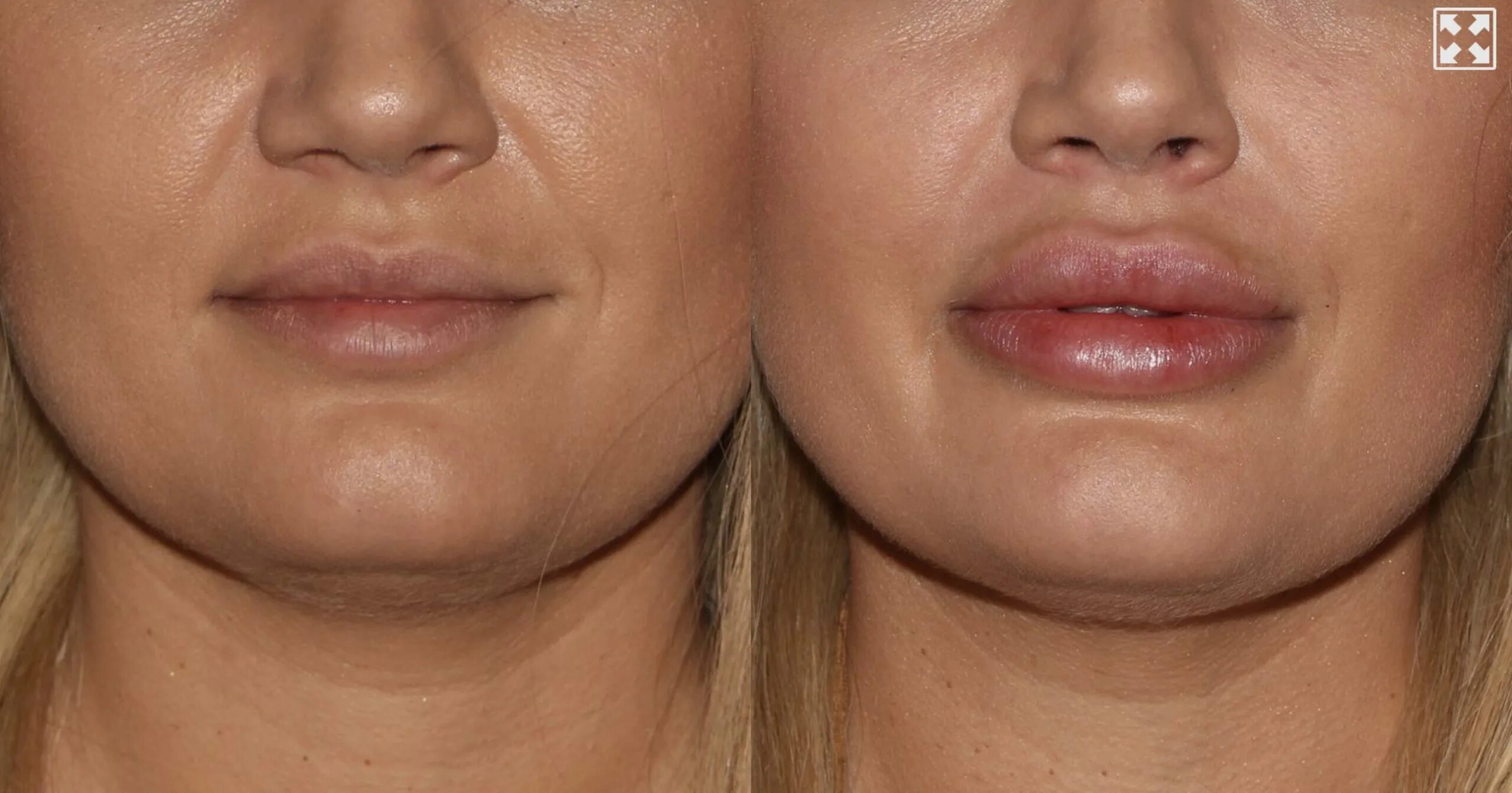 Бланширование лица. Бланширование межбровной складки. Бланширование морщин belotero. Бланширование лица. Бланширование носогубных морщин.