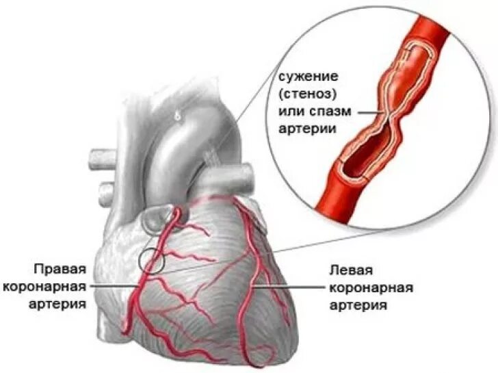 Атеросклероз левой коронарной артерии