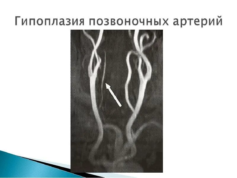 Гипоплазия правой артерии головного мозга. Аплазия позвоночной артерии. Гипоплазия v4 сегмента позвоночной артерии. Гипоплазия позвоночной артерии кт.