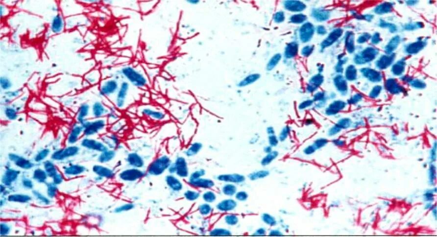Микобактерии по Цилю Нильсену. Микобактерии туберкулеза микробиология. Микобактериозы туберкулеза окраска по Цилю Нильсену. Туберкулез по Циль Нильсену.