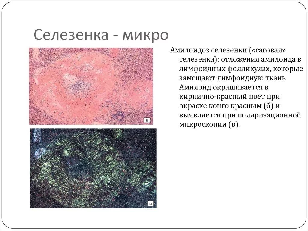 Саговая селезенка. Амилоидоз селезенки описание макропрепарата. Амилоидоз селезенки патанатомия. Амилоидоз селезенки сальная макропрепарат. Амилоидоз селезенки макропрепарат описание.