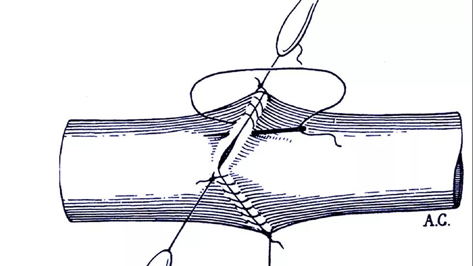 Сшивание нерва латынь. Алексис Каррель трансплантация. Алексис Каррель сосудистый шов. Эпиневральный шов нерва. Сосудистый шов по Каррелю.