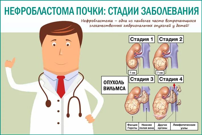 Нефробластома (опухоль Вильмса). Симптомы нефробластомы у детей. Рак почки рекомендации