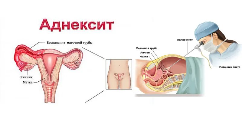 Подострый сальпингоофорит. Сальпингоофорит яичника. Хронический двухсторонний аднексит. Хронический двусторонний сальпингоофорит. Аднексид