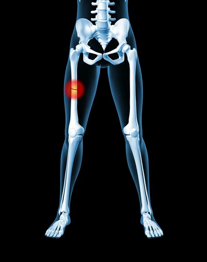 Женский скелет. Скелет женских бедер. Скелет человека с переломом костей. Скелет человека бедро.
