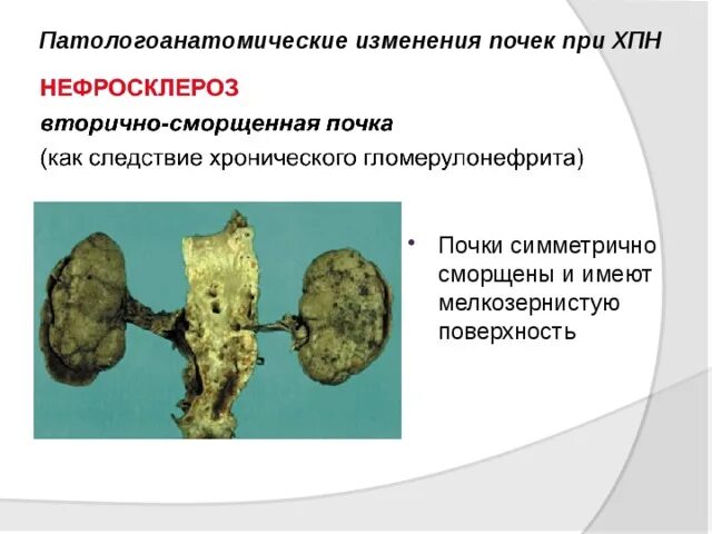 Первично сморщенная почка макропрепарат. Первичное сморщивание почки. Вторичносморшененя почка.