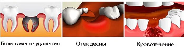 Альвеолит воспаление лунки. Альвеолит зубной лунки. Воспаление альвеолит лунки зуба. Как спать после удаления