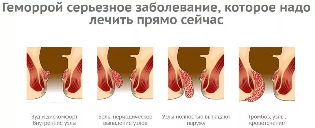 Схемы лечения тромбоза геморроидальных узлов