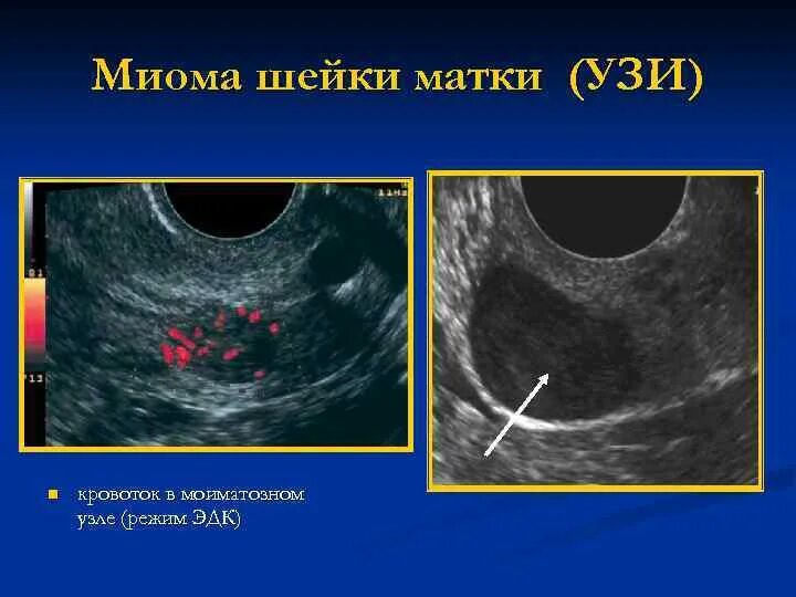 Шеечный миоматозный узел. Некроз миоматозного узла на УЗИ. Рак шейки матки на узи виден