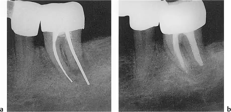Пломбирование гуттаперчевыми штифтами. Перфорация корня гуттаперча. Пломбировка каналов штифтами. Гуттаперчевый штифт на рентгене. Временное пломбирование корневых