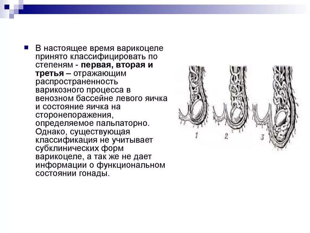 Варикозное расширение вен семенного канатика III степени. Варикозное расширение вен семенного канатика II степени. Варикоцеле расширение 3мм. Варикоз яичка 3 степени слева.