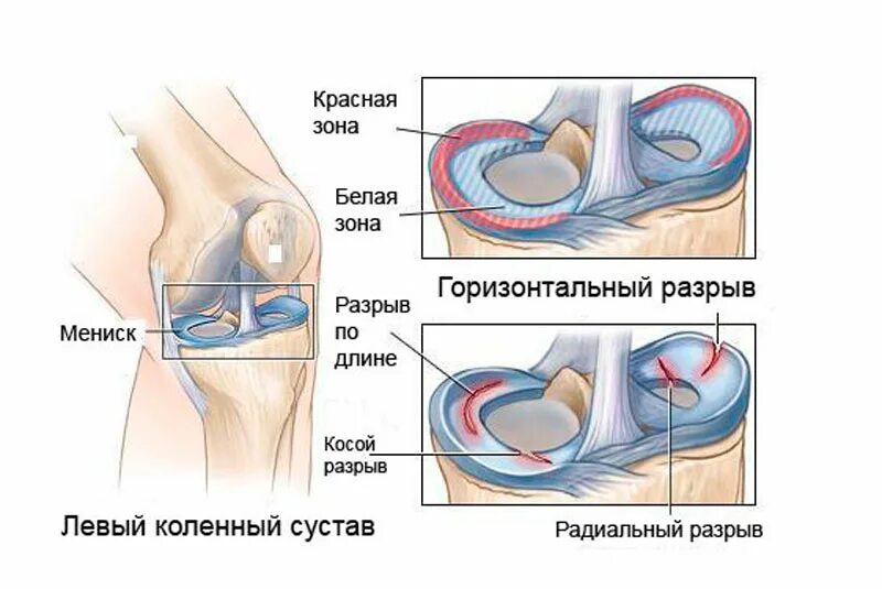 Болит ли мениск. Мениски коленного сустава анатомия разрыв. Мениски разрывы мениска коленного сустава. Горизонтальный разрыв медиального мениска. Повреждения внутреннего мениска левого сустава.