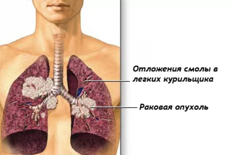 Стадии рака бронха. Доброкачественная опухоль легкого.