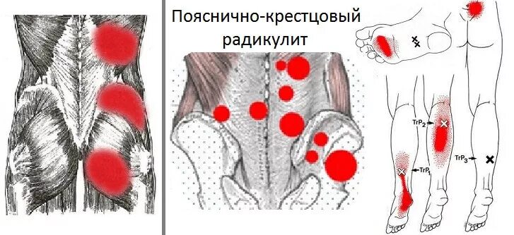 Боли в пояснице и ягодицах лечение. Клинический симптом пояснично-крестцового радикулита. Боль в спине триггерные точки. Триггерные точки поясницы и ягодиц. Клинический симптом пояснично-крестцовой радикулопатии.