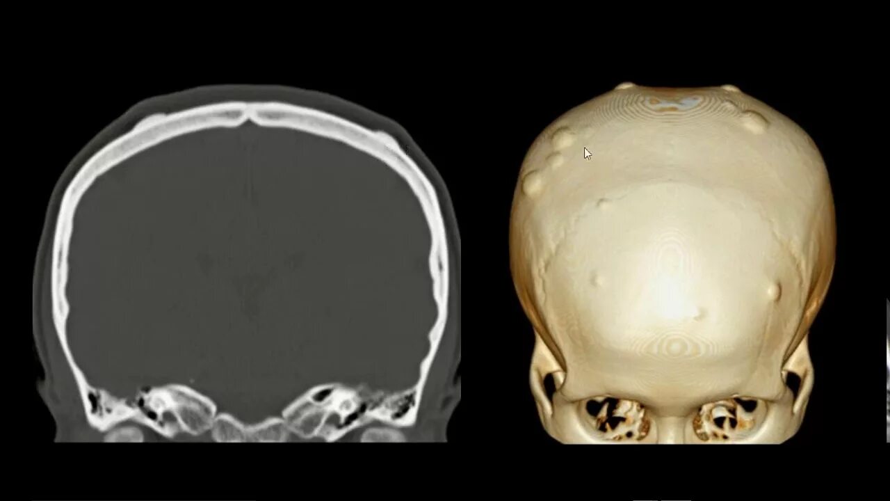 Образование кости черепа. Компактная остеома лобной кости кт. Остеома теменной кости на кт. Остеома кости черепа на кт. Остеома затылочной кости черепа.