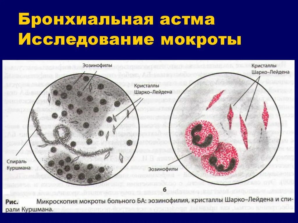 В мокроте можно обнаружить. Спирали Куршмана и Кристаллы Шарко-Лейдена. При исследовании мокроты при бронхиальной астме. Микроскопия мокроты при бронхиальной астме. Мокрота у пациентов, страдающих бронхиальной астмой.