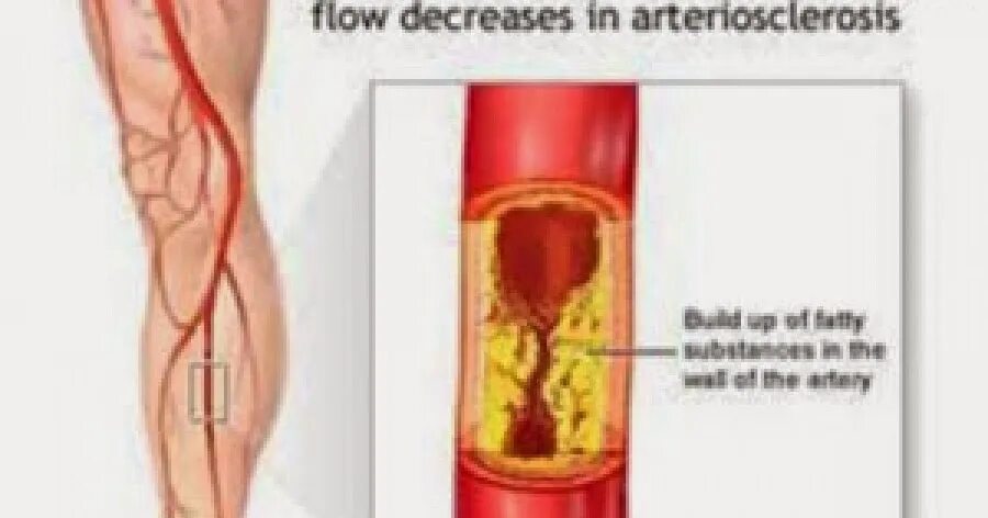 Симптомы закупорки артерий сосудов. Закупоривание сосудов на ногах. Закупорка головных сосудов