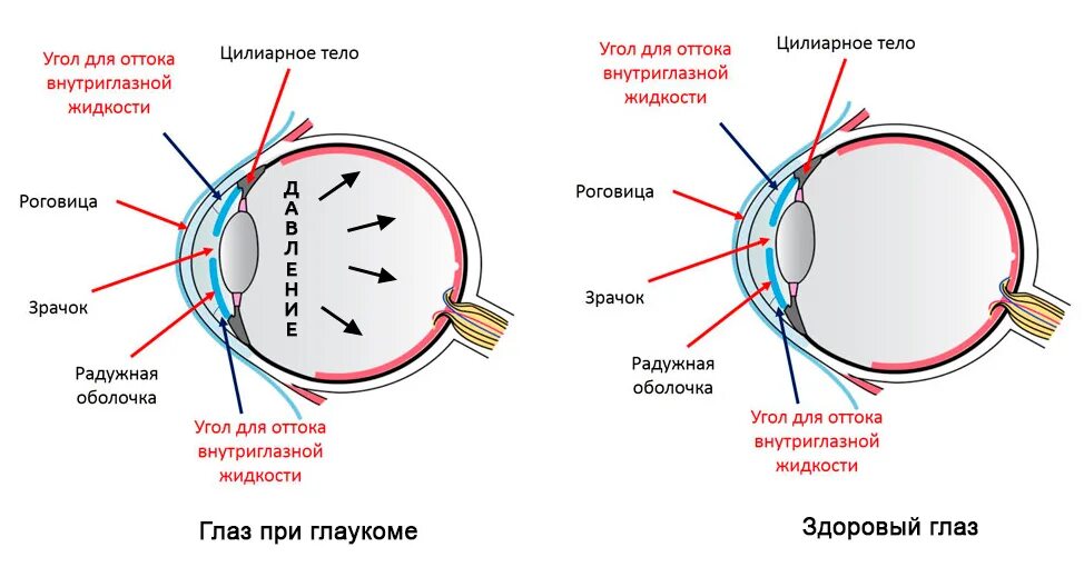 Патогенез первичной открытоугольной глаукомы. Глаукома схема глаза. Строение глаза при глаукоме. Механизм развития глаукомы. Причины глаукомы глаза