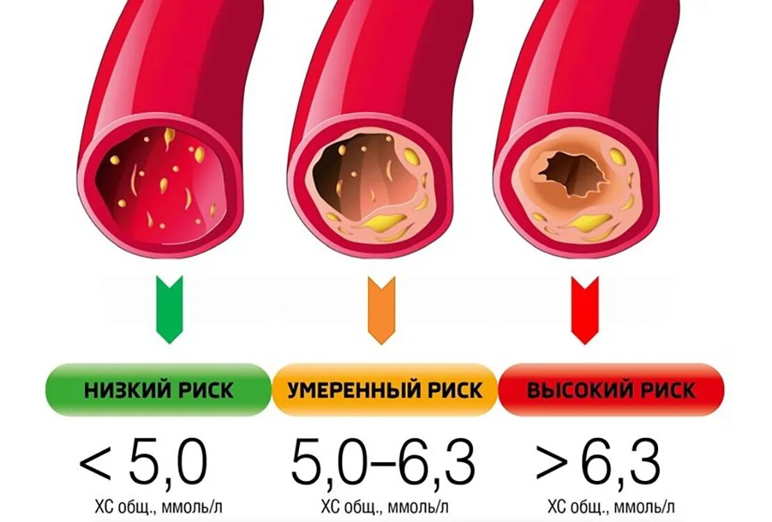 Холестерин 7 6 опасно ли это. Уровень холестерина. повышенный уровень холестерина.