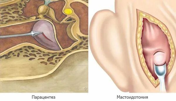 Парацентез барабанной перепонки. "Протокол операции парацентез" барабанной перепонки.