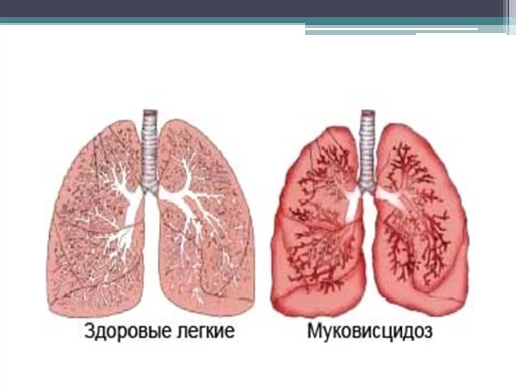 Болезни легких у детей. Муковисцидоз легочно кишечная форма.