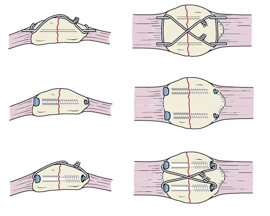 Перелом надколенника операция по Веберу. Остеосинтез коленной чашечки. Остеосинтез надколенника проволокой. Остеосинтез перелома коленной чашечки. Перелом надколенника операции