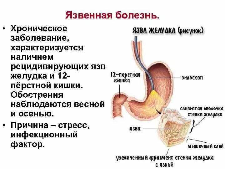 Признаки язвы 12 перстной кишки лечение. Болезнь желудка и 12 перстной кишки. Язвенная болезнь болезнь желудка и 12 перстной кишки. При язвенной болезни 12 перстной кишки. Язвенная болезнь желудка и 12 перстной кишки симптомы.