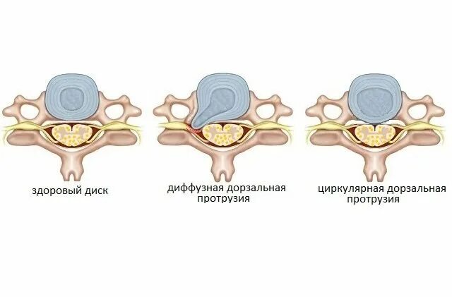 Дорзальная протрузия диска что это такое. Задняя центральная протрузия диска l3-l4. дорзальная диффузная протрузия диска l4l5. протрузия диска с5 с6 шейного отдела позвоночника. задняя циркулярная протрузия l3-l4 6мм.