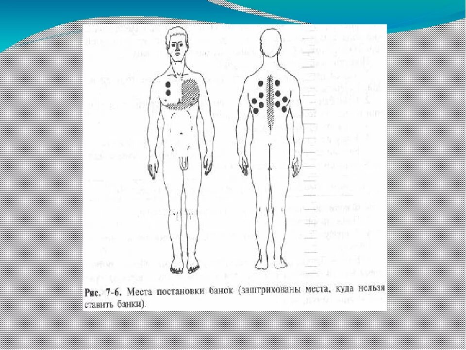 На сколько ставят банки на спину взрослым. Куда ставить банки на спину схема при кашле. Схема постановки банок при бронхите. Куда ставят банки при кашле схема. Вакуумные банки схема постановки.