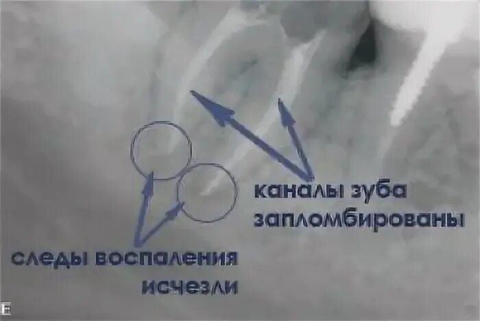 Какие каналы в зубе