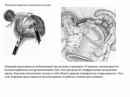 Хирургическое лечение грыж