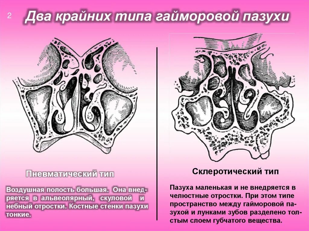 Пневматический Тип гайморовой пазухи. Типы строения верхнечелюстной пазухи. Строение гайморовых пазух. Гайморова пазуха анатомия клиническая.