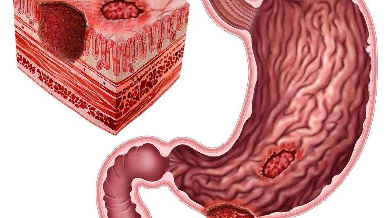 Малигнизация язвенной болезни. Малигнизация язвы желудка. Слизистая оболочка 12 кишки