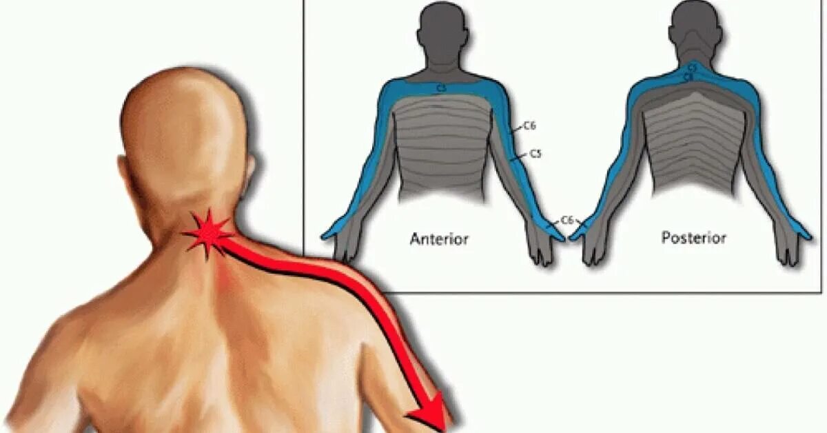 Шейно плечевой радикулит. Шейно плечевая радикулопатия. Шейные радикулопатии. Иррадиация в левую лопатку