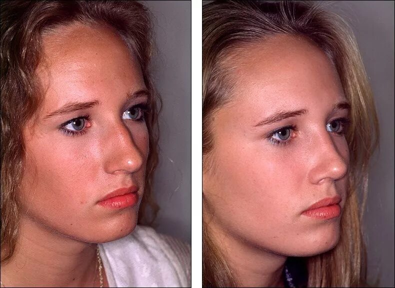 Steven M. Denenber, M.D. Rhinoplasty Laser hair, Rhinoplasty, Broken nose