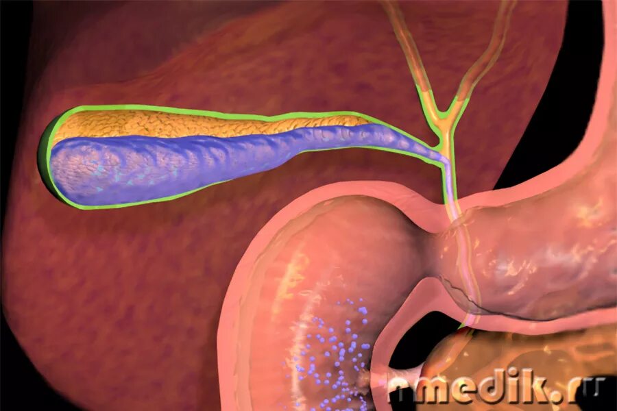 Накапливает желчь. Дисхолия желчного. Дисхолия желчного пузыря что это такое. Острый бескаменный холецистит.