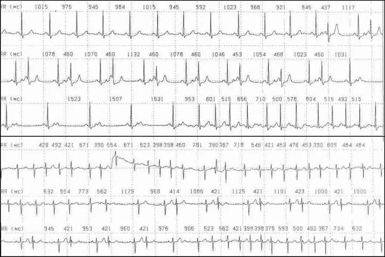 Фибрилляция предсердий на холтеровском мониторировании. Холтер фибрилляция предсердий заключение экг. Фибрилляция предсердий холтер. Суточное мониторирование экг заключение. Фибрилляция предсердий холтер.